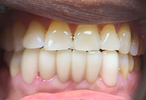 The image shows a close-up of a person s mouth with yellowed teeth, featuring a partial view of the lower teeth and the upper lip.
