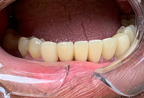 An image of a person s open mouth revealing a set of crooked teeth with visible dental work, focusing on the lower front teeth.