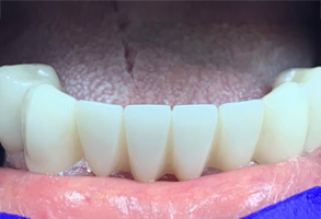 Smile Dental JC | Extractions, Implant Dentistry and Preventative Program