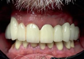 Smile Dental JC | Veneers, Laser Dentistry and Implant Restorations