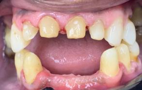 Smile Dental JC | Dental Cleanings, Night Guards and Digital Impressions