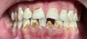 Smile Dental JC | Teeth Whitening, Extractions and Dentures