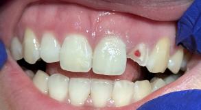 Smile Dental JC | Oral Cancer Screening, Air Abrasion and Implant Dentistry