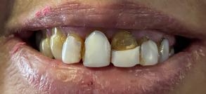 Smile Dental JC | Veneers, Ceramic Crowns and Implant Dentistry