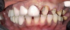 Smile Dental JC | Night Guards, Veneers and Implant Dentistry