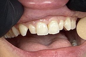 Smile Dental JC | Implant Dentistry, Ceramic Crowns and Periodontal Treatment