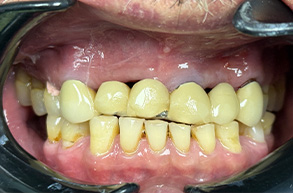 Smile Dental JC | Pediatric Dentistry, Implant Restorations and Preventative Program