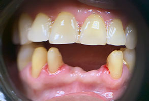 The image shows a close-up of a person s mouth with teeth that appear to be in poor condition, possibly indicating dental neglect or disease.