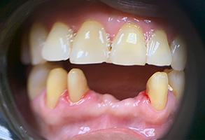 An image of a person s mouth with multiple teeth missing, showcasing a dental condition.