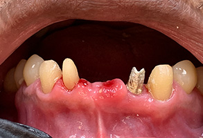 Gross, close-up of a person s mouth with severe tooth decay and red inflammation.