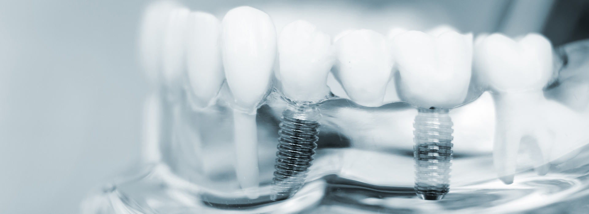 The image shows a close-up of a dental implant with screws and abutments, set against a blurred background that appears to be a mouthpiece or similar object.