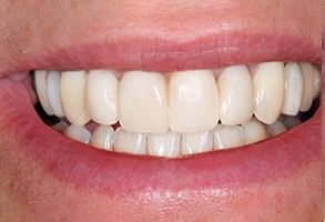 The image shows a close-up of a person's mouth with a radiant smile, displaying white teeth and pink gums.