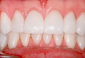 The image shows a close-up of a person's teeth with an emphasis on the upper front teeth, which appear to be in need of dental care.