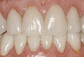 The image shows a close-up of a person's teeth with visible yellowing and staining, suggesting the need for dental care or whitening.