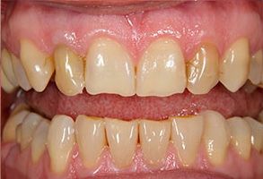 The image displays a close-up of a person's teeth with a focus on a mouth that appears to be in the process of being straightened or whitened, as indicated by the presence of braces and possibly teeth bleaching treatment.