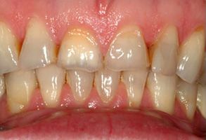 The image displays a close-up of a person's teeth with stains, showing the lower front teeth prominently.